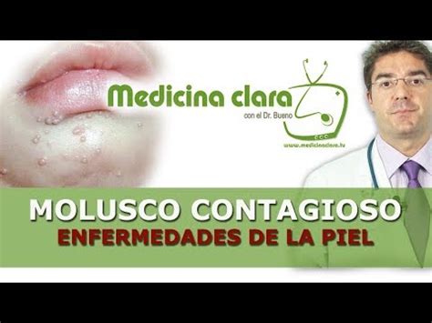 como eliminar molusco contagioso naturalmente|La última solución de remedios caseros de Molusco。